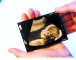 孕早期的B超数据