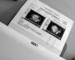 四维彩超双胞胎与单胞胎的区别
