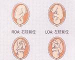 胎位loa能顺产吗