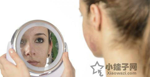 孕期长痘痘怎么办 孕期长痘痘 孕期下巴长痘痘