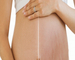 去妊娠纹的方法,有妊娠纹怎么办 8种方法为你解决妊娠纹烦恼