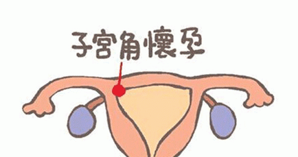 腹腔妊娠的原因