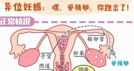 腹腔妊娠的治疗