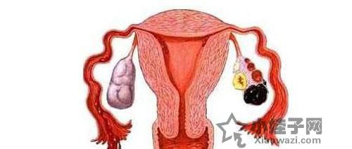 卵巢巧克力囊肿