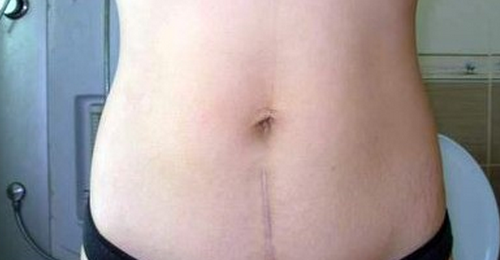 剖腹产疤痕增生