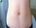 剖腹产疤痕痒,剖腹产疤痕增生