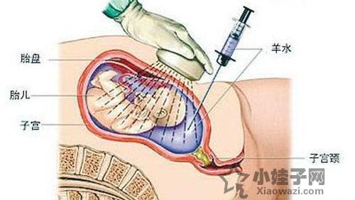 孕妈妈羊水过多怎么办?