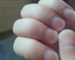 怀孕期间得了灰指甲影响，孕期得灰指甲咋办